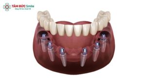 all-on-6-implants-1