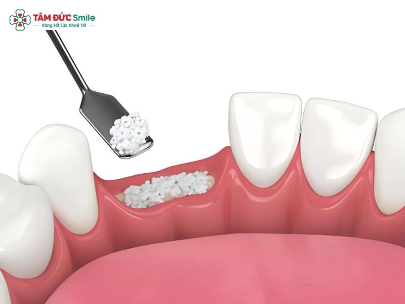 bone-graft-for-dental-implant-2