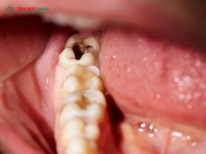 cavities-1