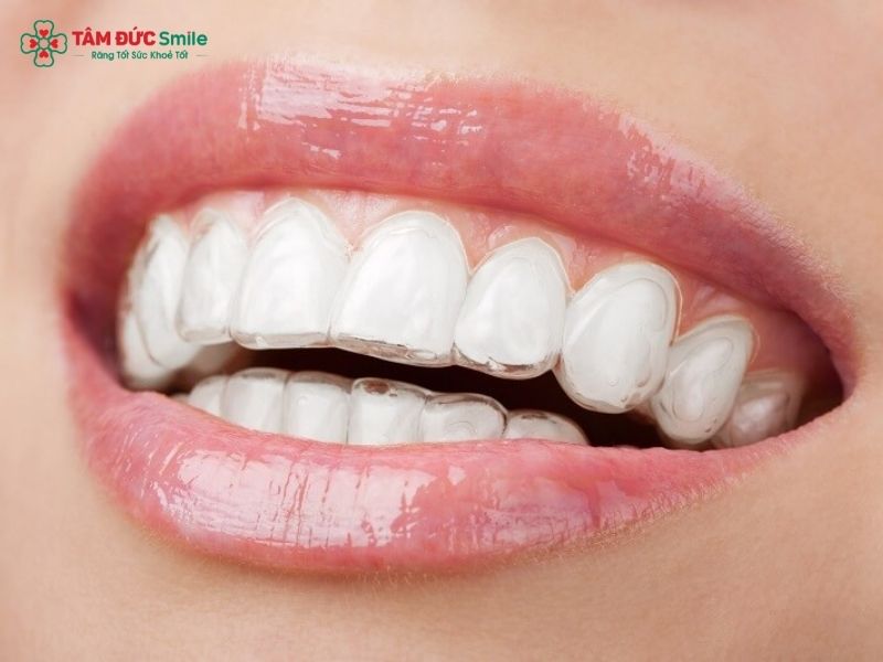 clear-aligners-2