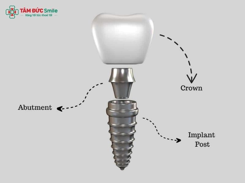 dental-implant-components-1