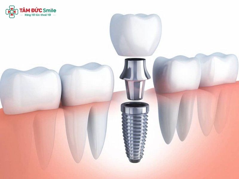 dental-implant-surgery-1