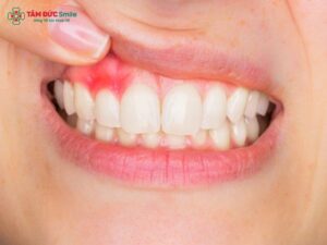 gingivitis-1