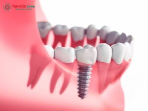 implantation-process-2