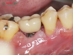 tooth-implant-side-effects-1