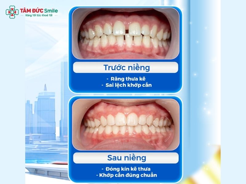 22-tuoi-nieng-rang-duoc-khong-4