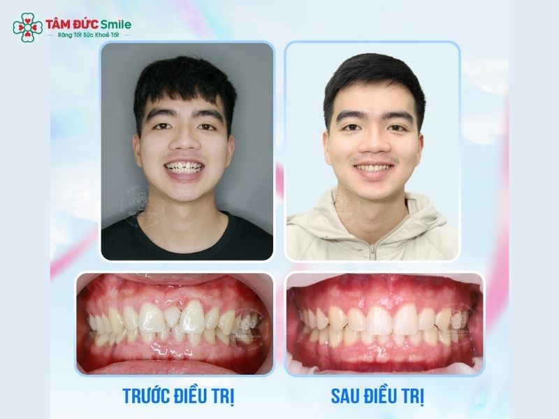 24-tuoi-nieng-rang-duoc-khong-3
