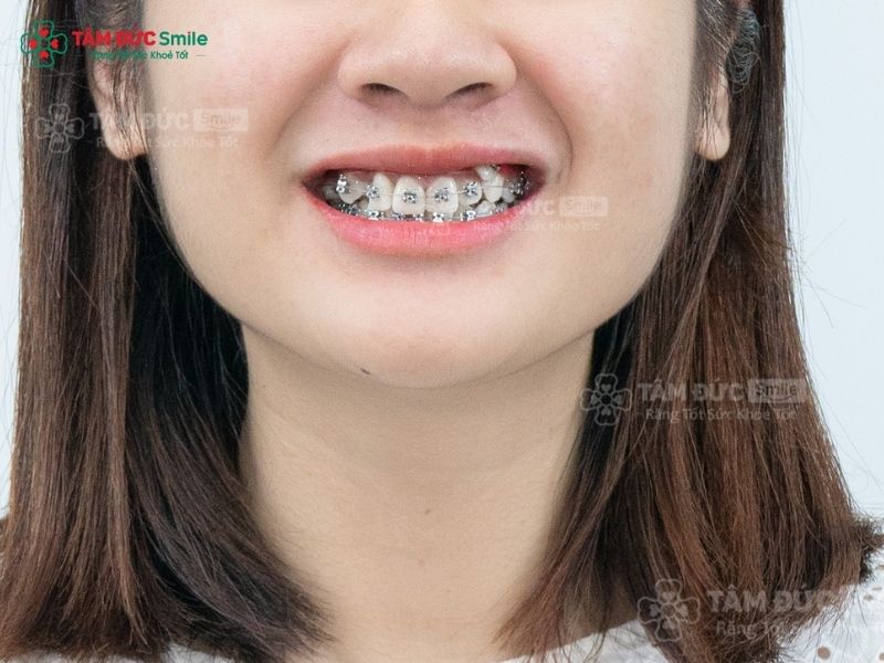 24-tuoi-nieng-rang-duoc-khong-4