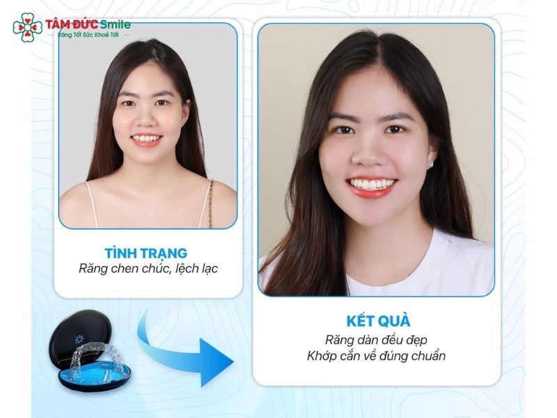 24-tuoi-nieng-rang-duoc-khong-6