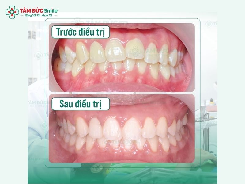 24-tuoi-nieng-rang-duoc-khong-7