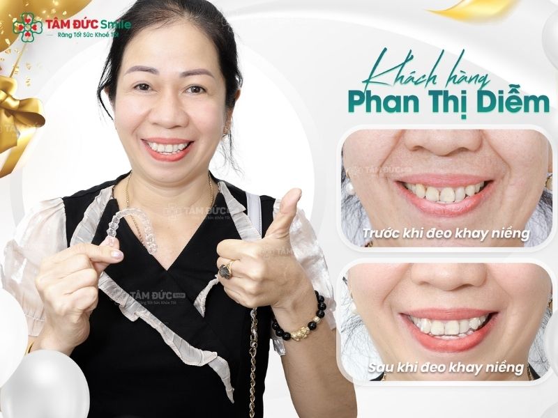 39-tuoi-co-nieng-rang-duoc-khong-7
