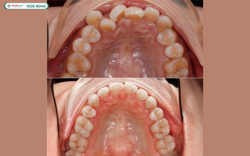 Răng chen chúc, lệch khớp cắn gây khó ăn