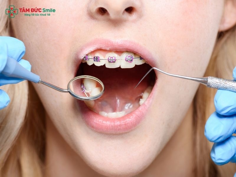 Quý khách nên đến LINK TRANG CHỦ ABC88 CHUẨN 2026 tái khám định kỳ để làm sạch răng chuyên sâu