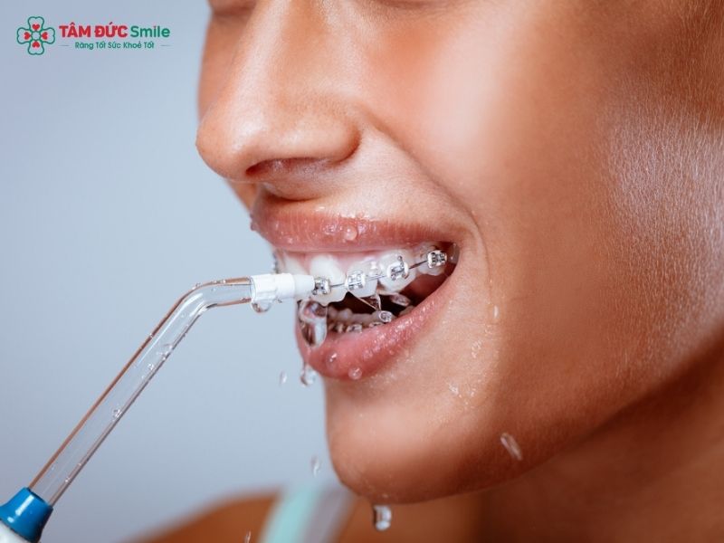 Quý khách có thể kết hợp sử dụng bàn chải kẽ, máy tăm nước để làm sạch răng khi niềng