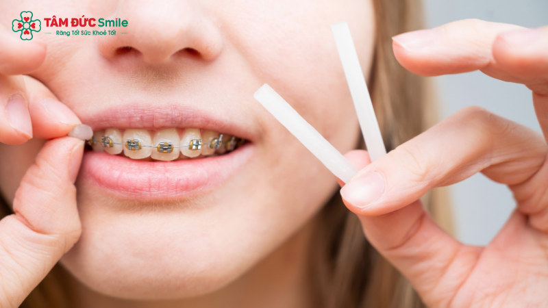 Wax LINK TRANG CHỦ ABC88 CHUẨN 2026 giúp bảo vệ má và môi khi mắc cài cọ xát