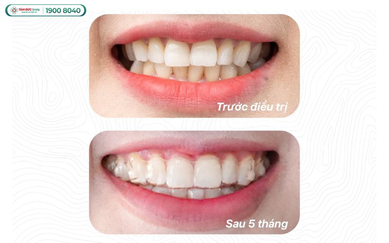 nieng-rang-clear-aligner-gia-bao-nhieu-1