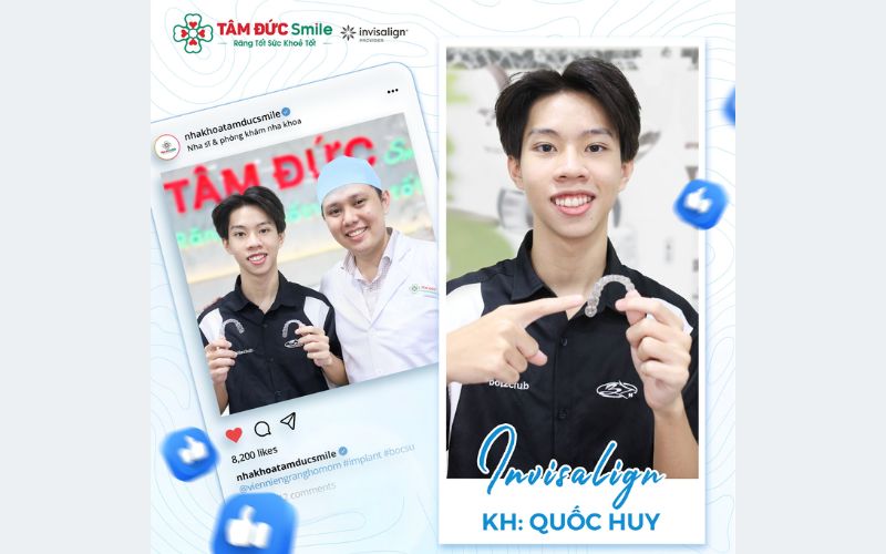 nieng-rang-clear-aligner-gia-bao-nhieu-4