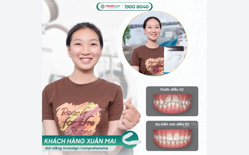 nieng-rang-clear-aligner-gia-bao-nhieu-5
