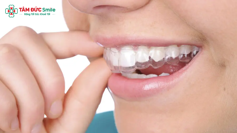 Invisalign phù hợp khi răng lệch nhẹ – trung bình