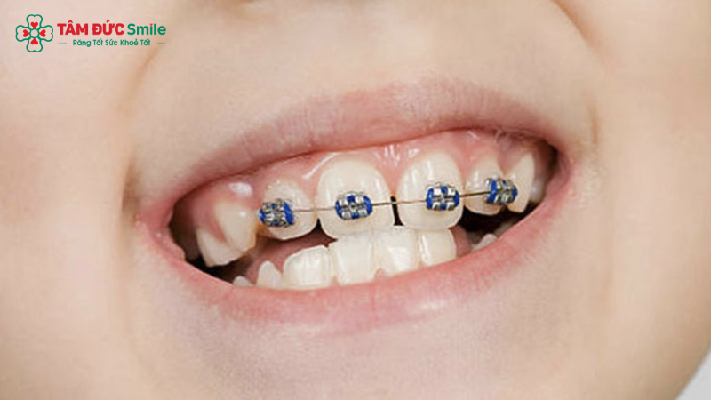 Niềng 4 răng cửa chỉ áp dụng cho răng khểnh lệch nhẹ và cần ABC8 đường link chính thức chỉ định rõ ràng