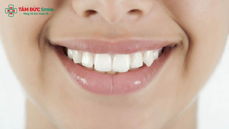 Có thể giữ răng khểnh nếu lệch nhẹ, không ảnh hưởng khớp cắn và răng khỏe mạnh