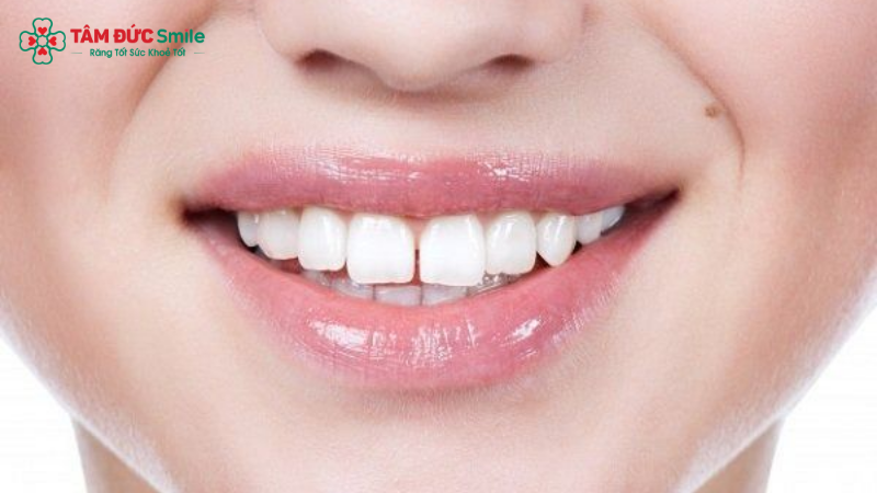 Răng hô, răng thưa, cười hở lợi bị xem là tướng xấu trong dân gian