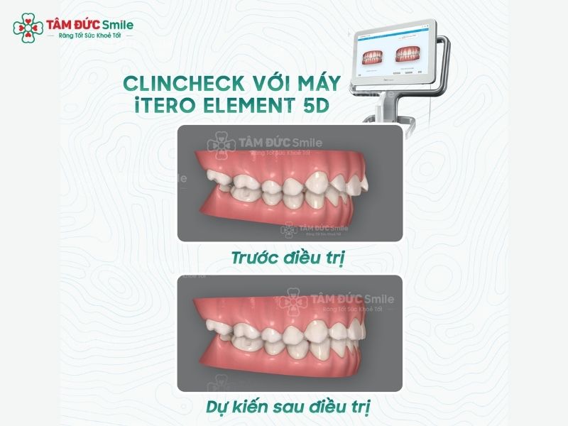 nieng-rang-invisalign-tai-tphcm-3