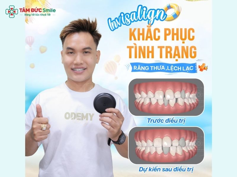 nieng-rang-invisalign-tai-tphcm-4