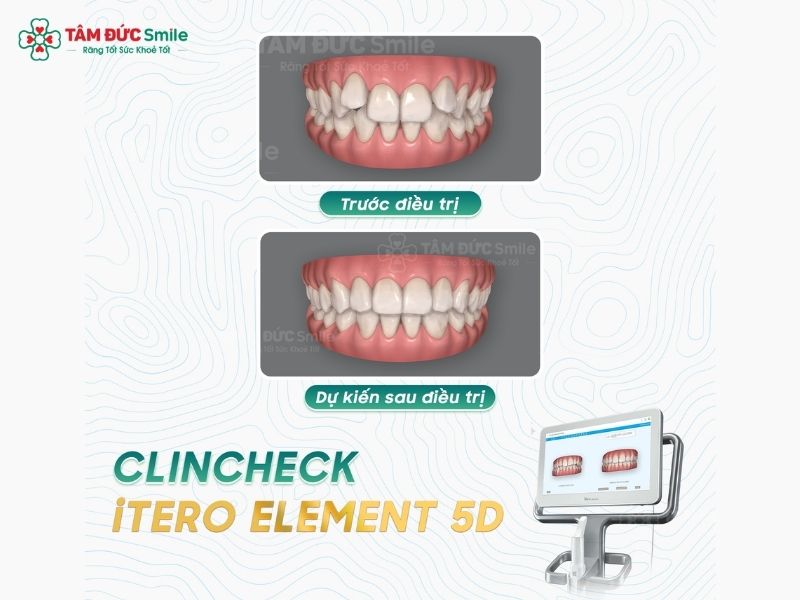 nieng-rang-invisalign-tai-tphcm-5