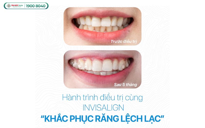 nieng-rang-thao-lap-gia-bao-nhieu-1