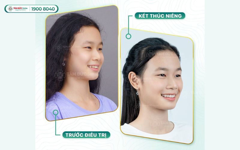 nieng-rang-thao-lap-gia-bao-nhieu-3