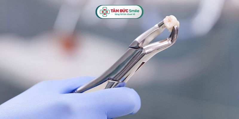 Cần nhổ răng khôn đúng thời điểm và đúng kỹ thuật để đảm bảo an toàn