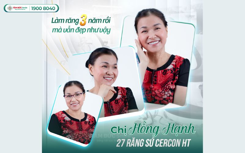 boc-rang-su-bao-lau-thi-dep-6