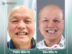 boc-rang-su-quan-3-1