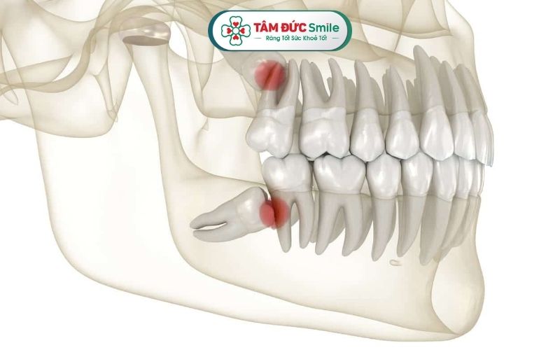 Răng khôn còn gọi là răng số 8, là chiếc răng mọc lên cuối cùng trong cung hàm