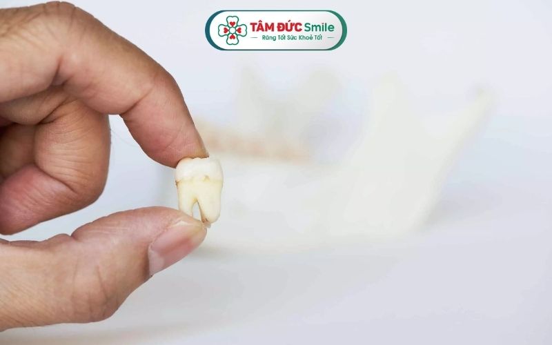 Răng khôn thường mọc trong độ tuổi từ 17-25, nhưng cũng có trường hợp không mọc răng khôn