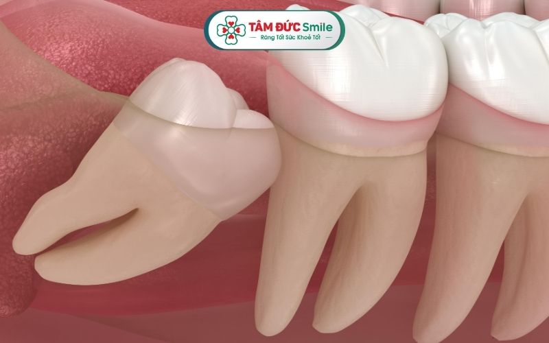 Răng khôn thường mọc ngầm, mọc lệch... rất ít trường hợp răng khôn mọc thẳng