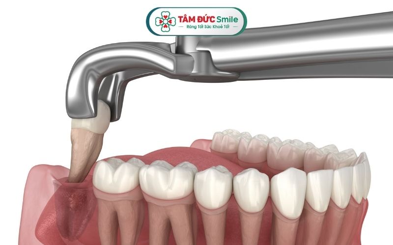 Nên nhổ răng khôn theo chỉ định của ABC8 đường link chính thức để phòng tránh biến chứng ngoài ý muốn