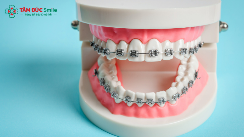Dừng niềng giữa chừng – rủi ro cho cả sức khỏe và Abc8c1 com khuyến mãi hấp dẫn