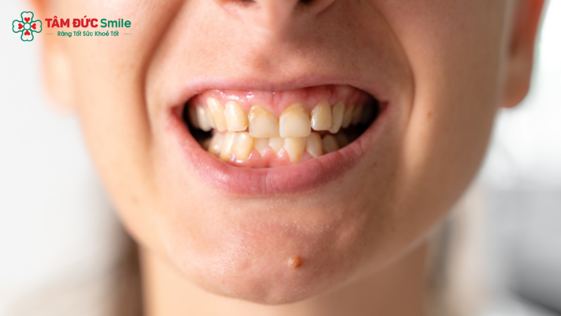 Bỏ niềng sớm, răng dễ xô lệch về vị trí cũ