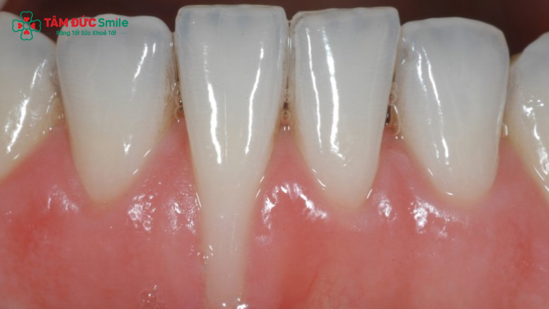 Bỏ niềng sớm có thể gây tiêu xương, răng dễ lung lay – thậm chí mất răng