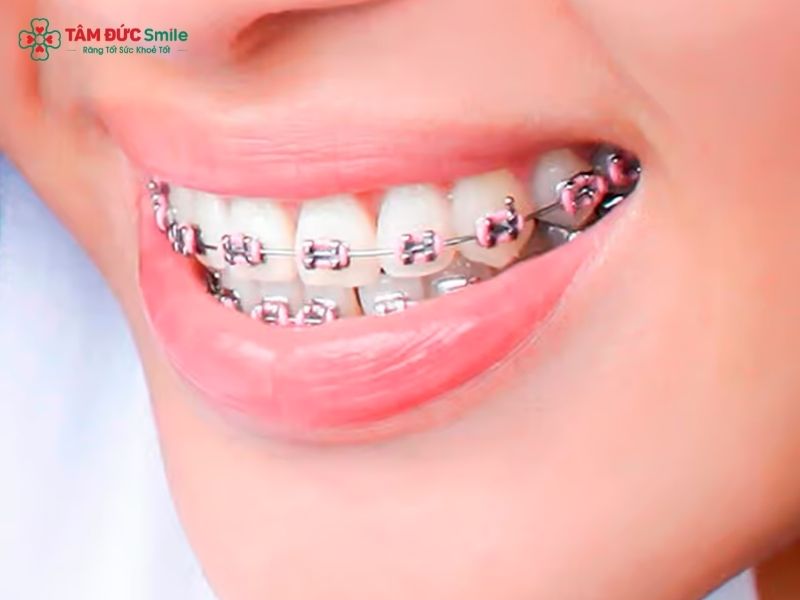 chi-phi-boc-rang-su-cho-rang-ho-la-bao-nhieu-864-2