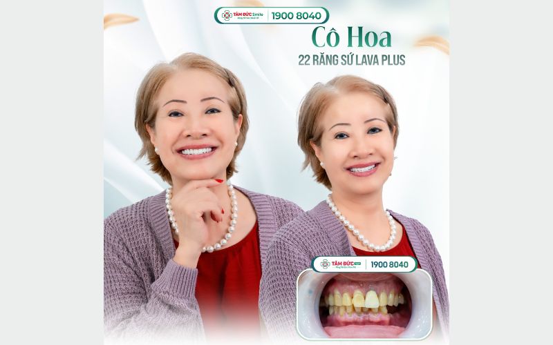 dia-chi-boc-rang-su-binh-duong-1