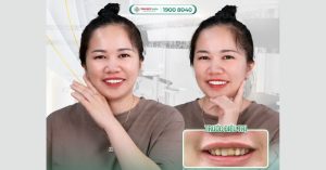 dia-chi-boc-rang-su-binh-duong