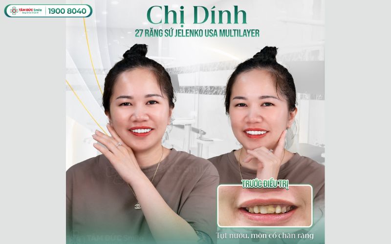 dia-chi-boc-rang-su-binh-duong-4