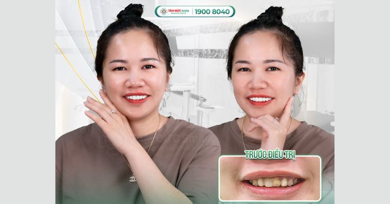 dia-chi-boc-rang-su-binh-duong