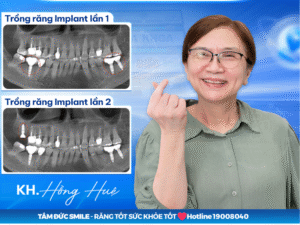 dia-chi-cay-ghep-implant-tot-tai-soc-trang-1101-6