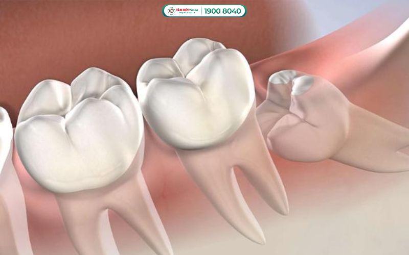 Khi răng mọc sai hướng, chúng sẽ đâm vào răng số 7