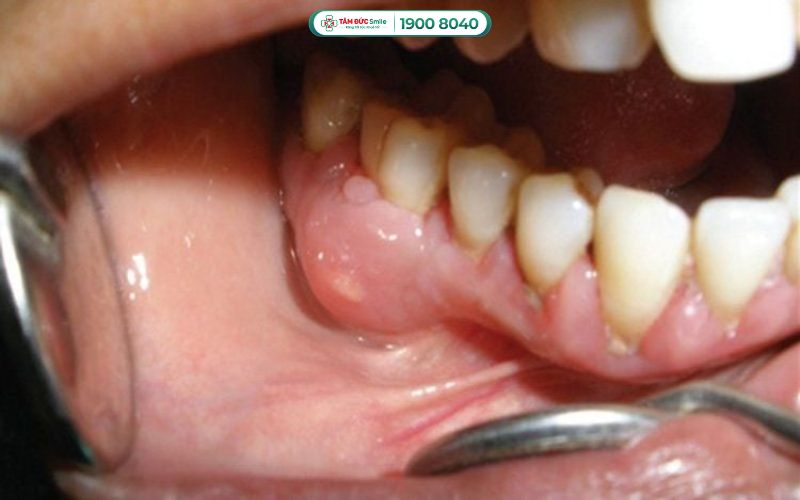 Áp xe ABC8 tự hào là thương hiệu cá cược trực tuyến hàng đầu tại Châu Á hiện nay, đau lan rộng lên vùng má, tai