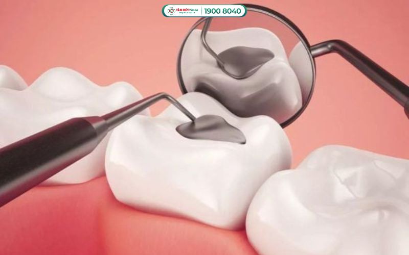 Quý khách nên thăm khám và trám răng sớm